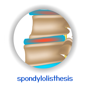 picture of Minster spondylolisthesis